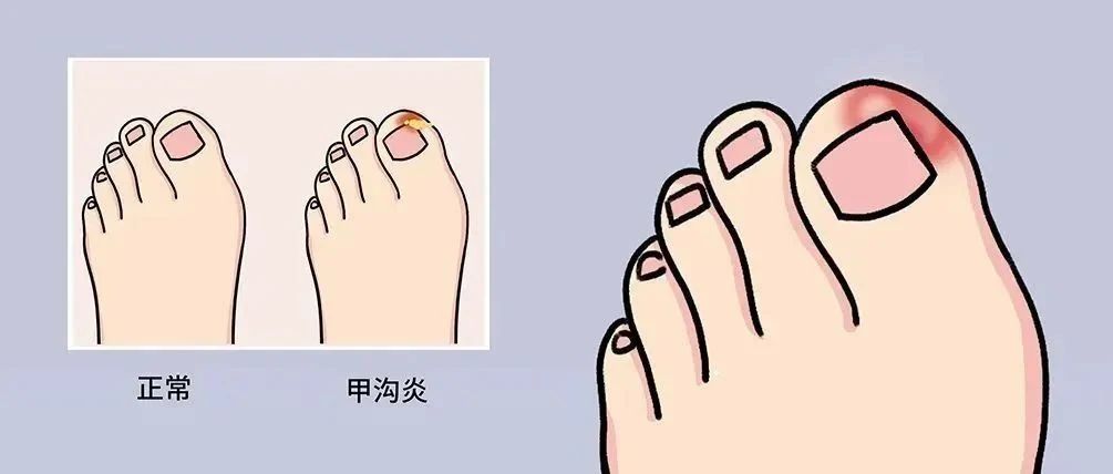 全面解析甲沟炎成因、诊断与治疗，最新甲沟炎科普视频发布